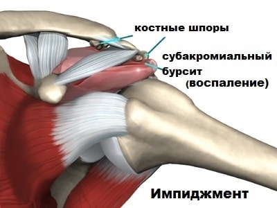 Надостная мышца плечевого сустава 124
