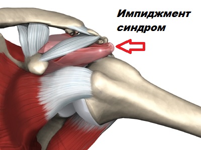 Надостная мышца плечевого сустава 132
