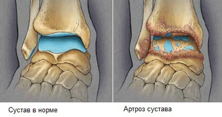 Народные средства от артроза голеностопного сустава 126