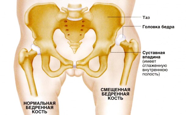 Ножка тазобедренного сустава 7