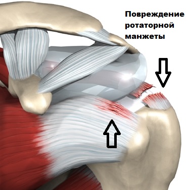 Операция манжеты плечевого сустава 113