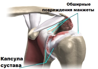 Операция манжеты плечевого сустава 18