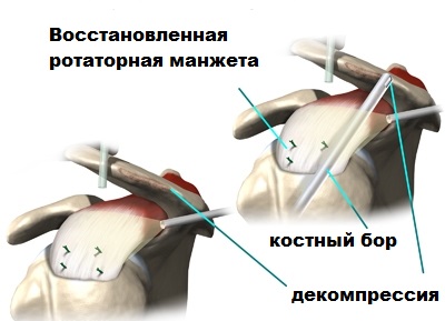 Операция манжеты плечевого сустава 90