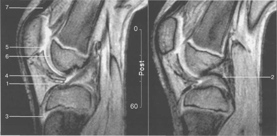 Операция на связки коленного сустава период 44
