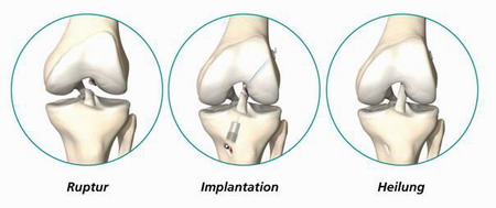 Операция на связки коленного сустава период 93