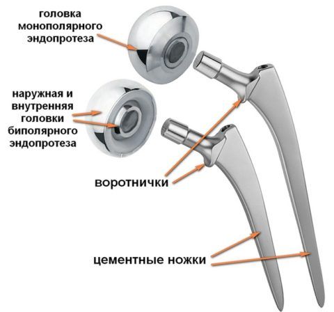 Операция по замене тазобедренного сустава в России 142