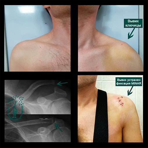 Операция связок плечевого сустава лечение 55