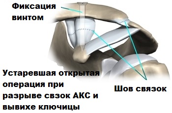 Операция связок плечевого сустава лечение 194