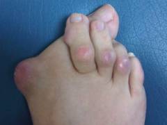 Опухоль сустава большого пальца ноги 114