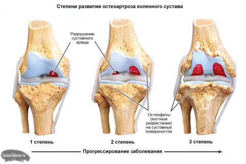Остеоартроз коленного сустава профилактика 170