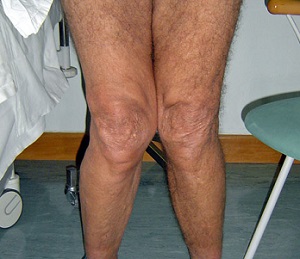 Острая боль при артрозе коленного сустава 76