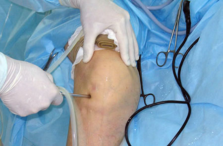 Отек ноги после артроскопии коленного сустава 135