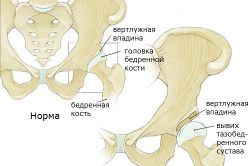 Пеленание при дисплазии тазобедренных суставов у грудничка 36
