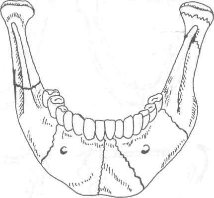 Перелом сустава челюсти 123