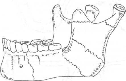 Перелом сустава челюсти 151