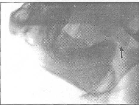 Перелом сустава челюсти 166