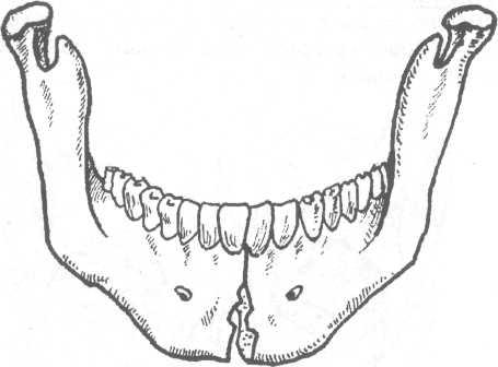 Перелом сустава челюсти 19
