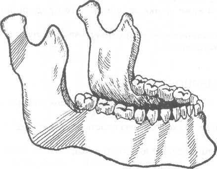 Перелом сустава челюсти 182