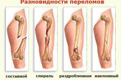 Перелом сустава плеча 95