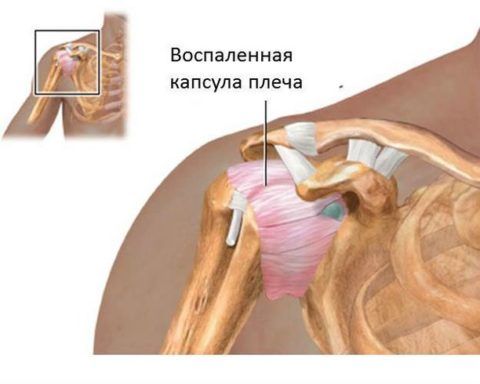 Периартрит плечевого сустава лечение симптомы причины методы 154