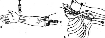 Плечевой сустав травматология 175