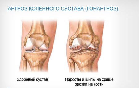 Почему возникает артроз коленного сустава? 182