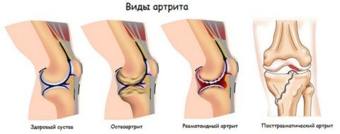 Подагрический артрит коленного сустава 52