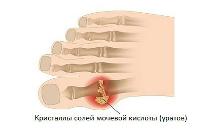 Подагровый артрит голеностопного сустава 112