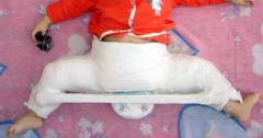 Подвывих тазобедренного сустава у новорожденных 147