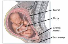 Подвывих тазобедренного сустава у новорожденных 33