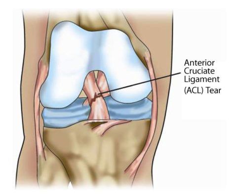 Повреждение коленного сустава симптомы 2