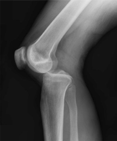 Повреждение коленного сустава симптомы 68