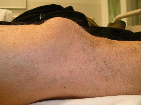 Повреждение коленного сустава симптомы 134
