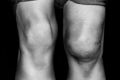 Повреждение коленного сустава симптомы 118