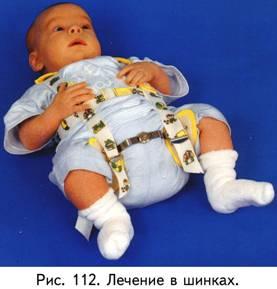 Предвывих тазобедренного сустава у новорожденных лечение 30