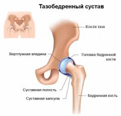Препараты для лечения коксартроза тазобедренного сустава 183