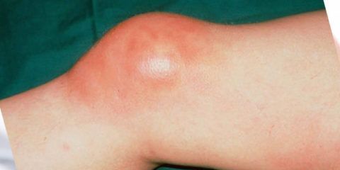 Препателлярный бурсит коленного сустава симптомы и лечение 139