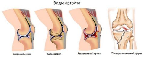 Признаки артрита коленного сустава 89