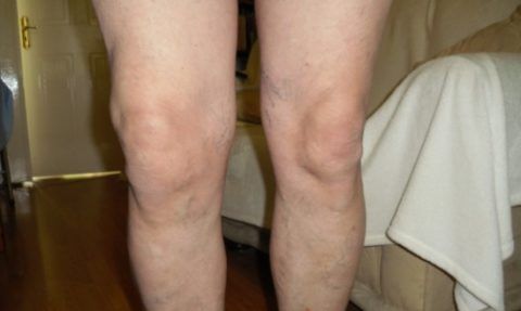 Признаки артрита коленного сустава 124