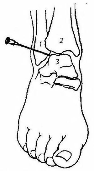 Укол в голеностопный сустав. Пункция коленного сустава точки пункции. Пункция голеностопного сустава топографическая анатомия. Блокада голеностопного сустава техника. Пцнкция голеностопного Сус.