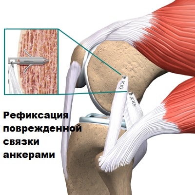 Растяжение коллатеральной связки коленного сустава 59