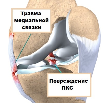 Растяжение коллатеральной связки коленного сустава 58