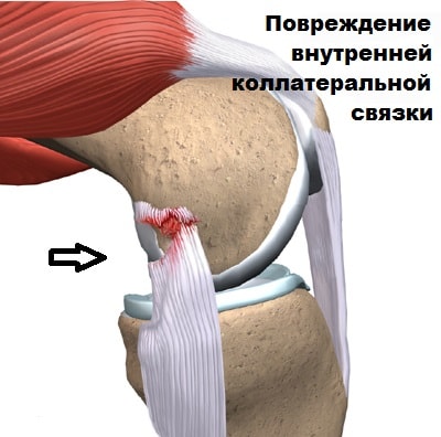 Растяжение коллатеральной связки коленного сустава 188