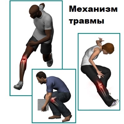 Растяжение коллатеральной связки коленного сустава 119