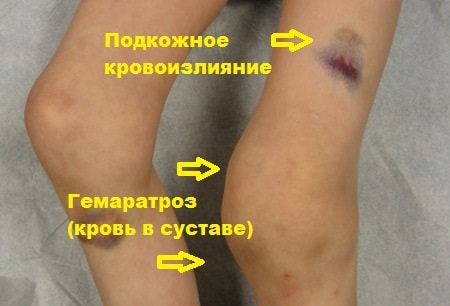 Растяжение коллатеральной связки коленного сустава 160