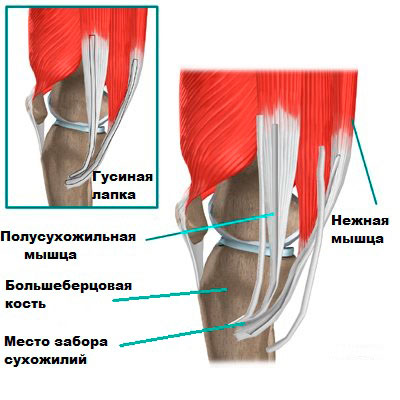 Реконструкция коленного сустава 10