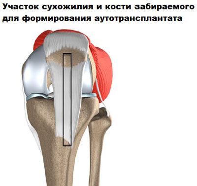Реконструкция коленного сустава 78