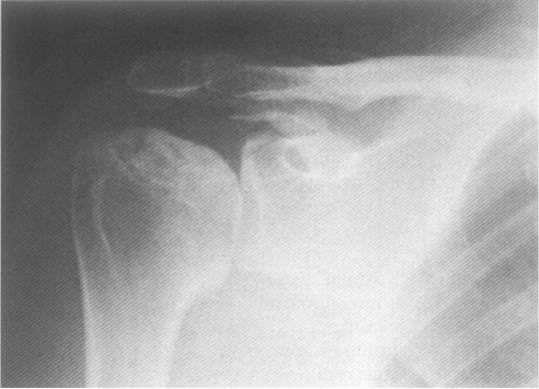 Рентген плечевого сустава что показывает 140
