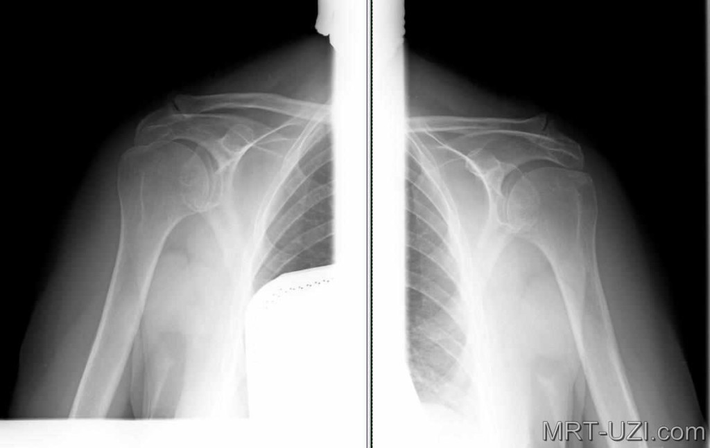 Рентген плечевого сустава что показывает 86