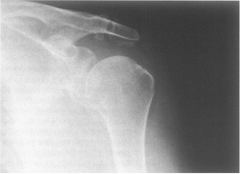 Рентген плечевого сустава что показывает 29
